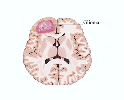 Glioma