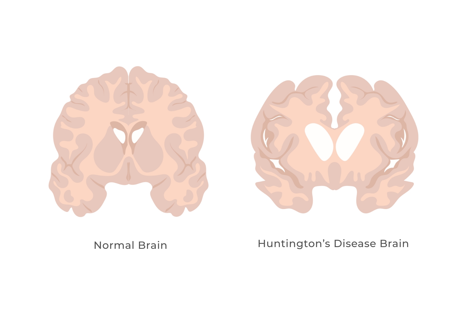 Huntington's disease (HD)